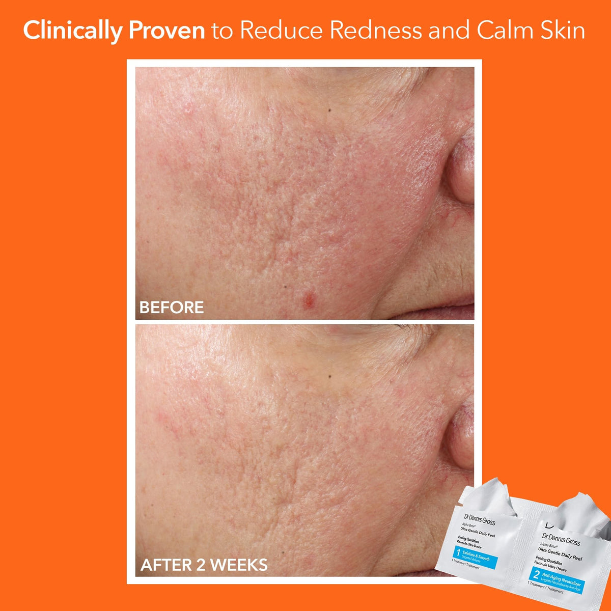 Dr. Dennis Gross clinical two step exfoliating treatment pads for dehydrated skin
