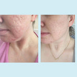 Perfect Image Glycolic Acid Gel Peel authentic USA imported skincare product