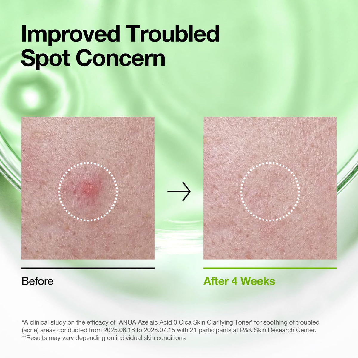 Textured shot of the lightweight Anua azelaic acid serum absorbing quickly on skin