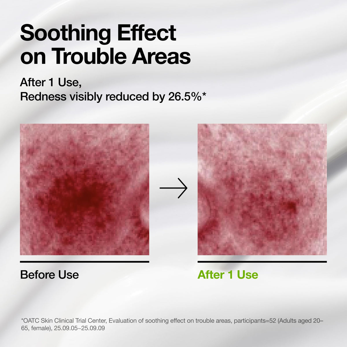 Anua azelaic acid cream for soothing sensitive skin barriers