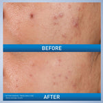 CeraVe salicylic acid blemish gel tube displaying key active ingredients