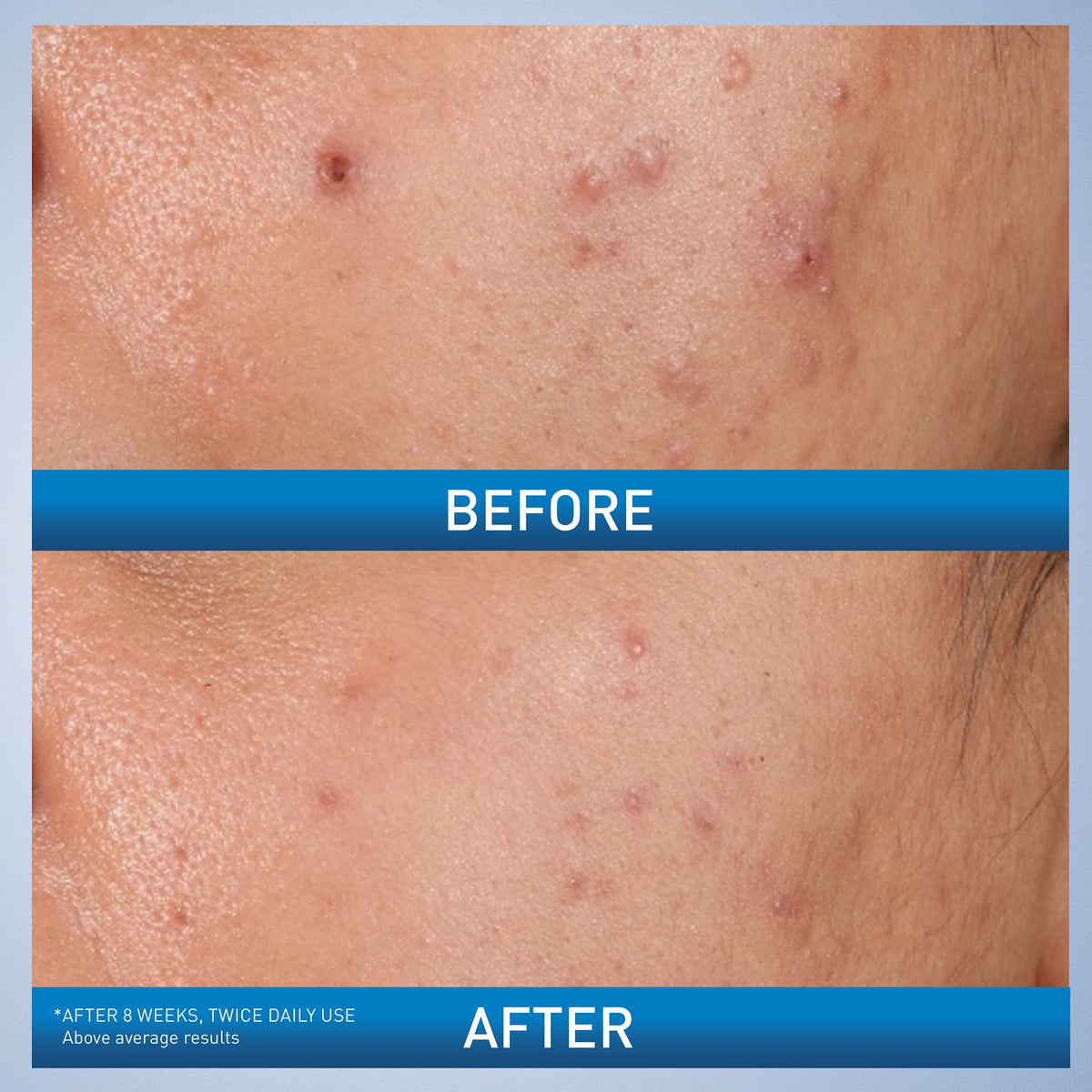 CeraVe salicylic acid blemish gel tube displaying key active ingredients