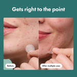Side view of the authentic USA imported packaging for early stage hidden pimple patches