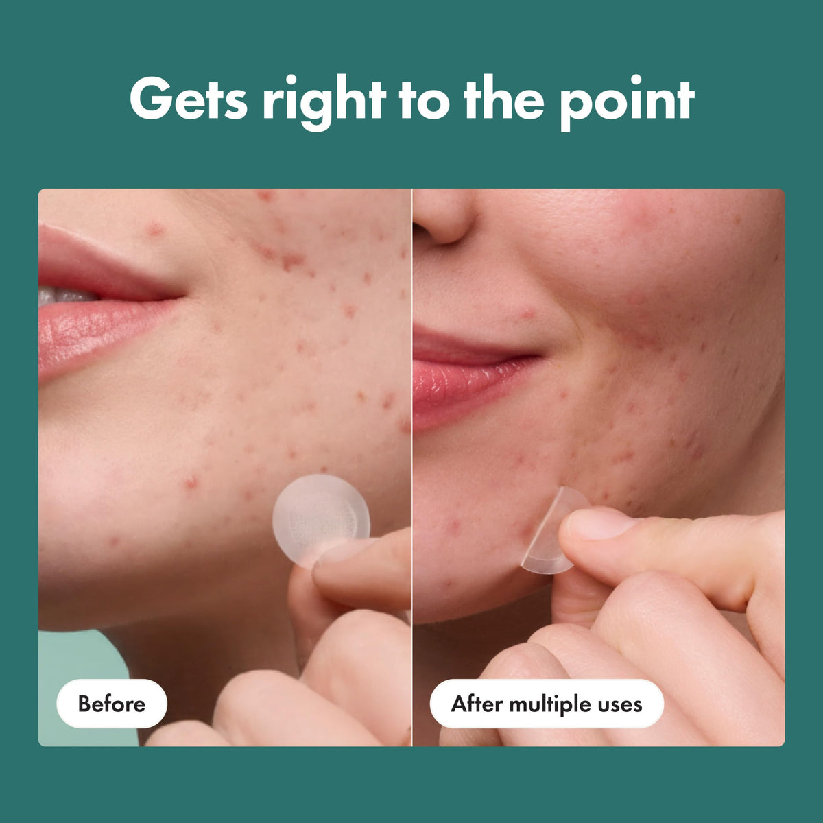 Side view of the authentic USA imported packaging for early stage hidden pimple patches