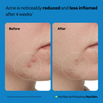 Authentic imported USA skincare toner for clearing breakouts and blackheads