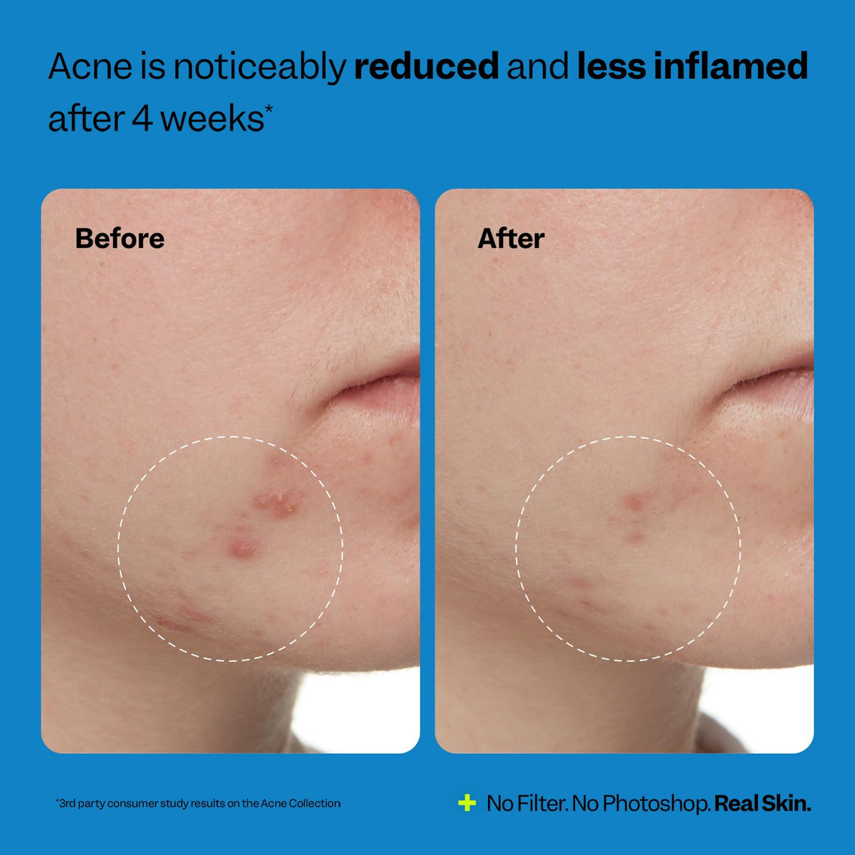 Authentic imported USA skincare toner for clearing breakouts and blackheads