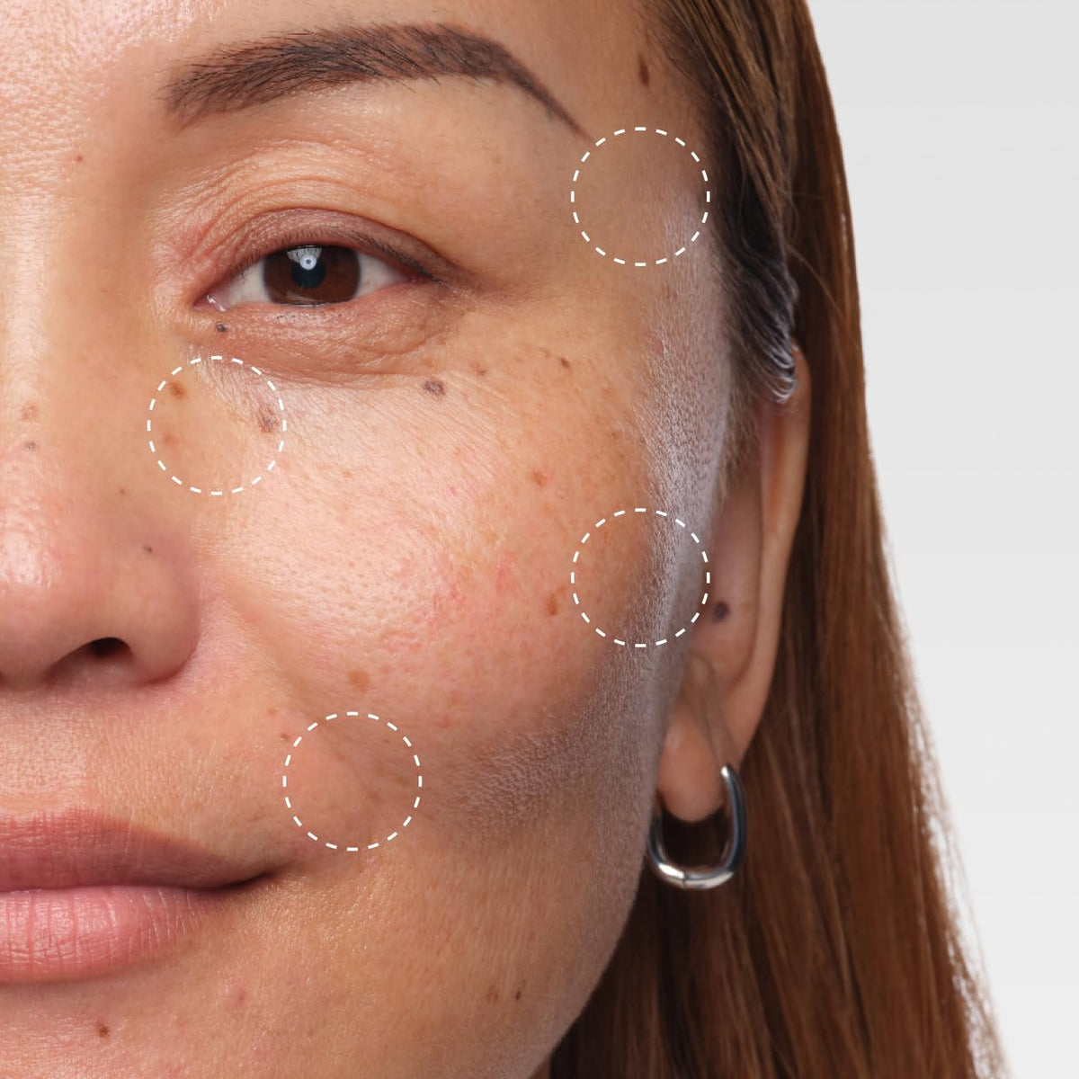 The Ordinary Volufiline 92% target areas - under-eye hollows, cheeks and smile lines for volume loss
